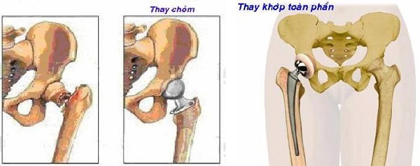 Ảnh 1 của Femoral Fracture